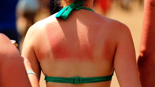 Die Haut verzeiht einen Sonnebrand nicht. Die Folgen können sich erst Jahre später zeigen