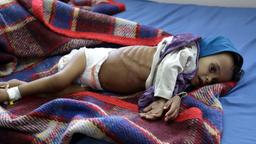 Stark unterernährte Kinder im Krankenhaus in Sa'da. Hunger und das weitgehend zusammengebrochene Gesundheitssystem führen zu solchen Bildern. Mütter haben zu wenig Essen und können ihre Babies nicht stillen, Kinder werden auf der Flucht krank,  Durchfall und Erbrechen schwächen den Körper. 