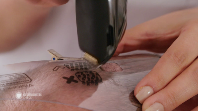 Bild: Das Erste Wir messen die genaue Haardichte nach, normal wären 200 Haare pro Quadratzentimeter Kopfhaut.