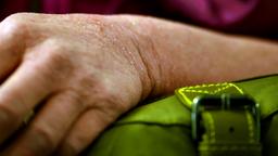 Arm einer Neurodermitis-Patientin