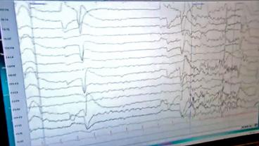 EEG eines Epilepsie-Patienten