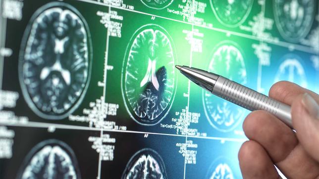Alzheimer ist häufigste Form der Demenzerkankung