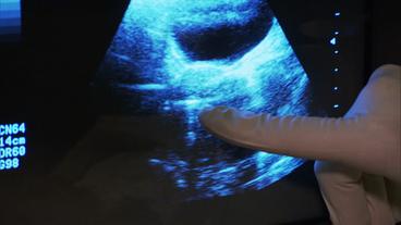 Ein Finger mit einem Handschuh deutet auf ein Ultraschall-Bild