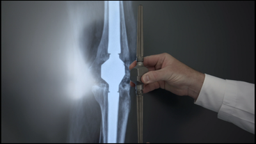 Bild: SWR Röntgenbild und Knieimplantat