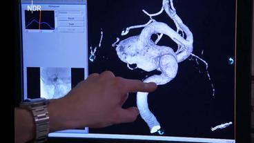 Bild: NDR 3D-Modell zeigt ein Aneurysma