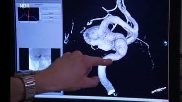 3D-Modell zeigt ein Aneurysma