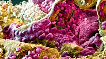 Aufnahmen von Krebszellen unter dem Rasterelektronenmikroskop