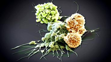 Bild: Oliver Meckes, Eye of Science Immunabwehrzellen greifen Krebszelle an.