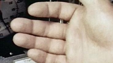 Bild: WDR Durch Druckverlust im All angeschwollene Hand