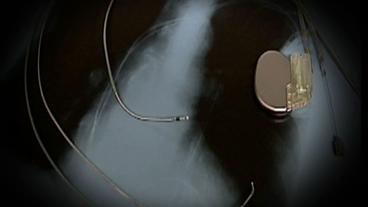 Bild: SWR Ein Defibrillator