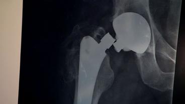 Röntgenbild der gebrochenen Hüfte
