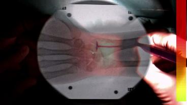 Das Bild des Handgelenks in einer Mischung aus Real- und Röntgenbild