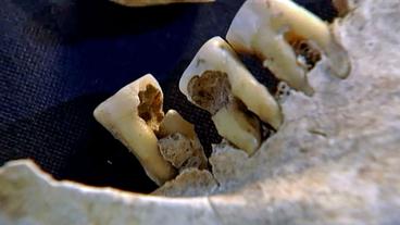 Alter Kieferknochen mit Zähnen, die Löcher haben und beschädigt sind