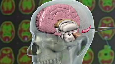 Schematische Darstellung der Entfernung des linken Hippocampus