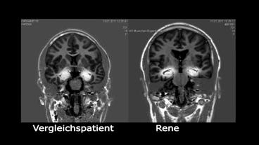 Scan von Renes Gehirn und dem eines Vergelichspatienten