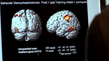 Computerbildschirm mit Darstellungen des Gehirns