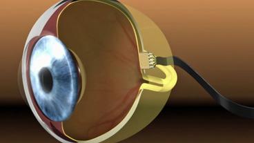 Bild: SWR Animation vom Chip im Auge