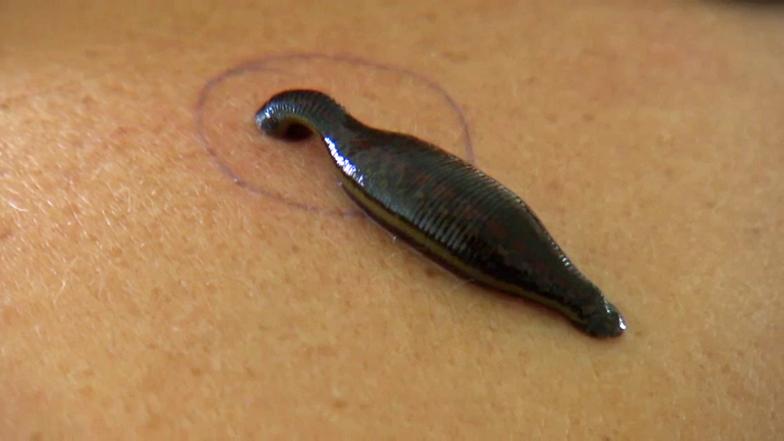 BlutegelTherapie W wie Wissen ARD Das Erste