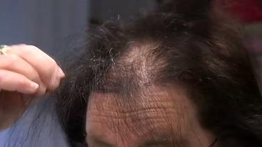 Vorderkopf einer Frau mit schütterem Haar