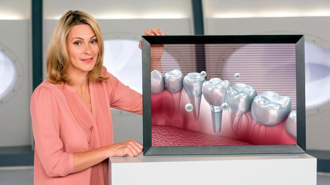 Wenn man schon einen Zahn verliert, so kann man in Zukunft über das Zahnimplantat nicht nur Lücken schließen, sondern auch dafür sorgen, dass der Rest des Gebisses von Karies verschont bleibt. Anja Reschke stellt die neuen High-Tech-Implantate vor – bei Wissen vor acht - Zukunft.